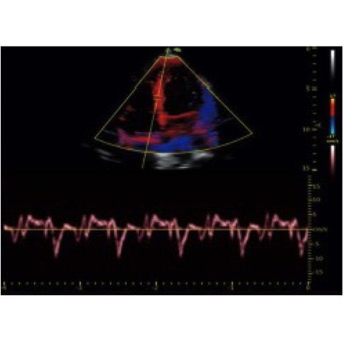 Modulo Doppler continuo Vinno