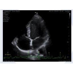 Modulo ECG para Ultrasonido Vinno